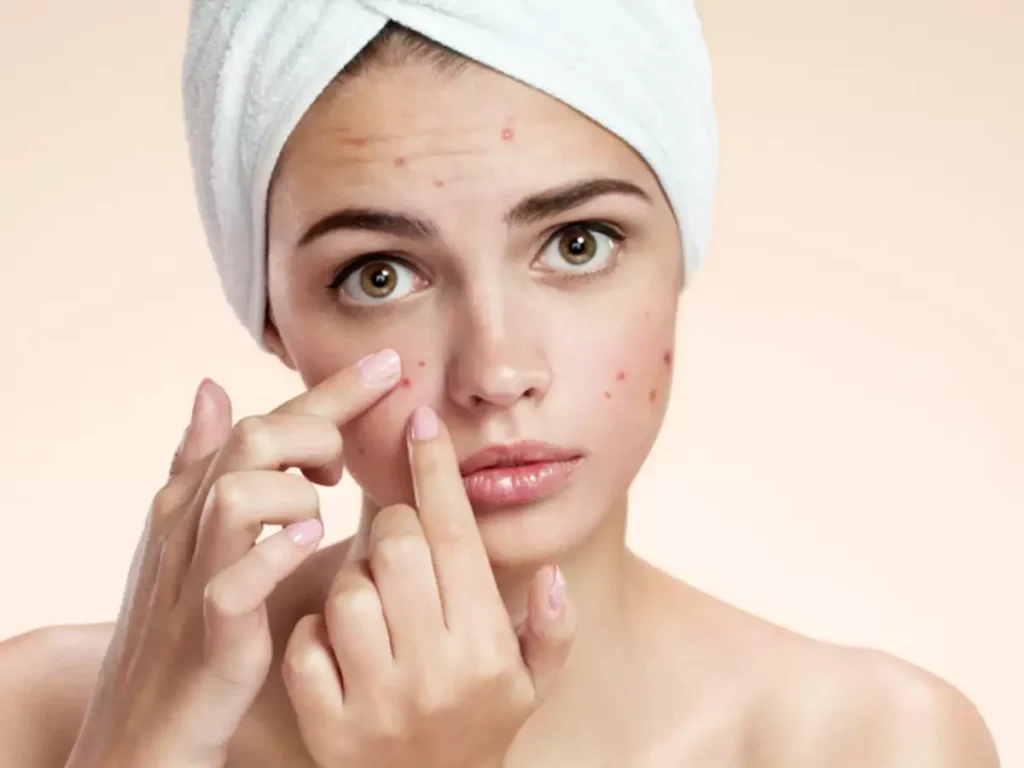 Types, Causes, and Treatment of Acne Scars