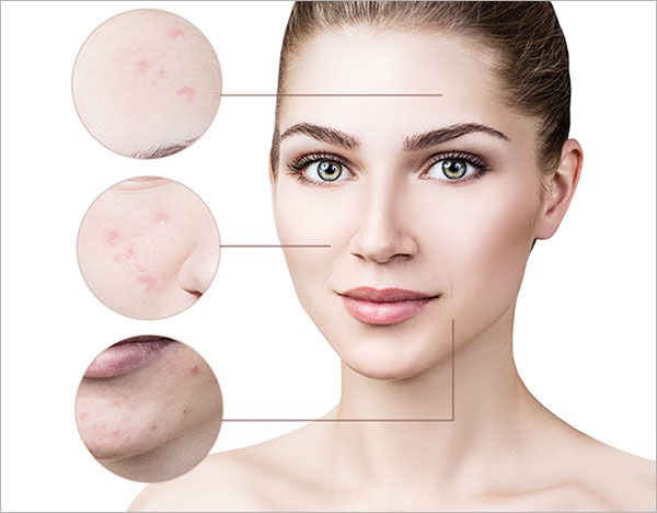 best-pimple-scar-removal-clinic-in-india-dr-priyas-skin-and-hair-clinic