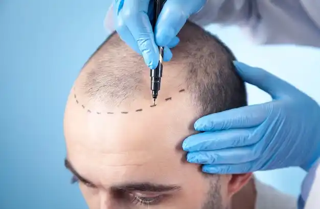 Everything You Need To Know About Hair Transplant