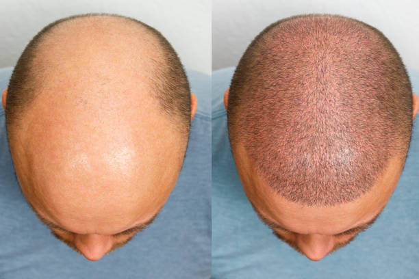 After a hair transplant, how long does it take for the hair to grow back