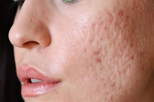 Best Acne Treatment in Thane