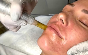 microneedling treatment in thane