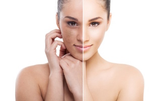 pigmentation treatment in thane