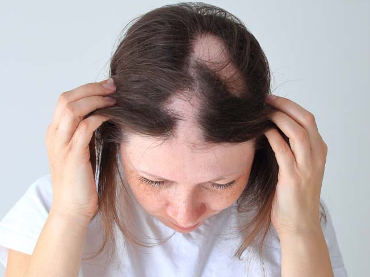 alopecia areata treatment in thane