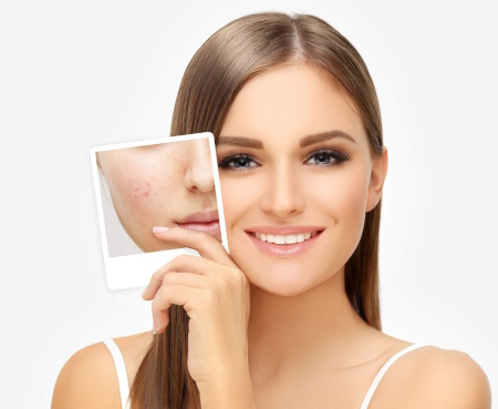 Best Acne Treatment in Thane