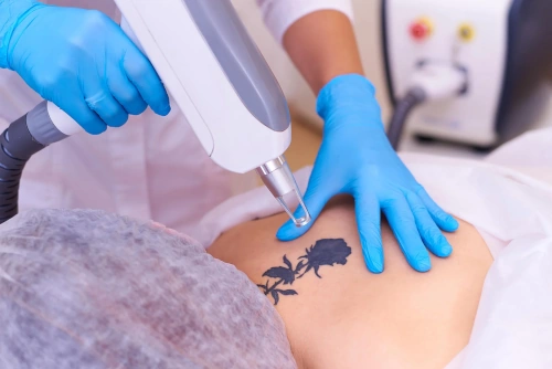 laser tattoo removal treatment in thane