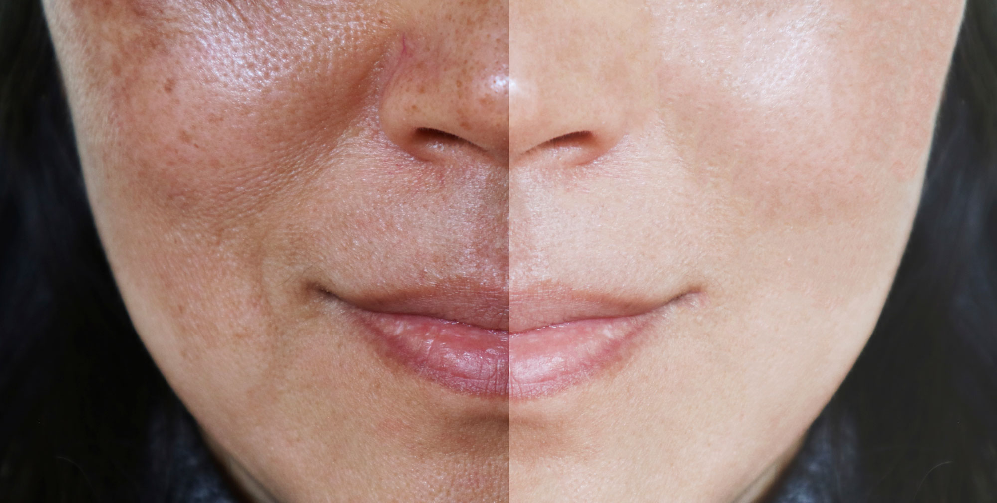 pigmentation treatment in thane