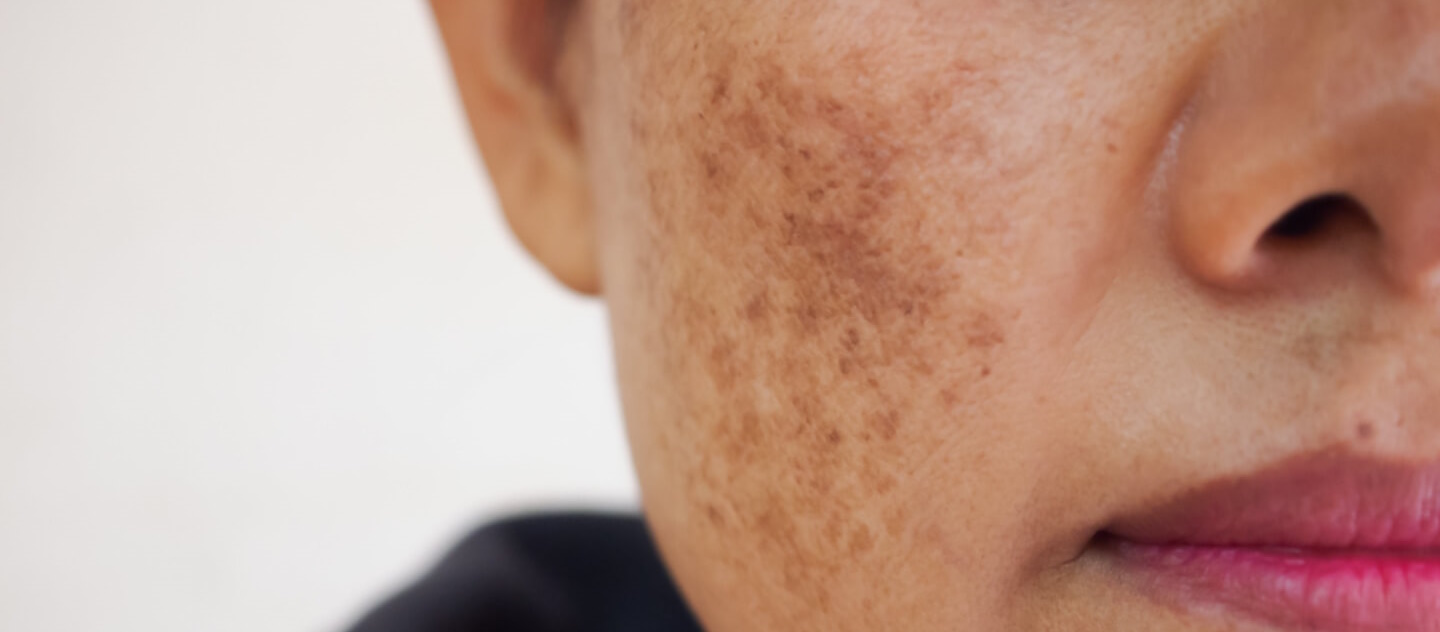 melasma treatment in thane