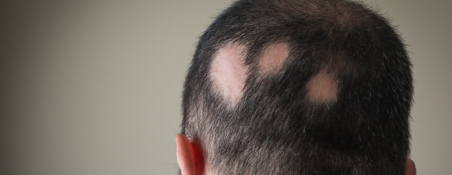 alopecia areata treatment in thane