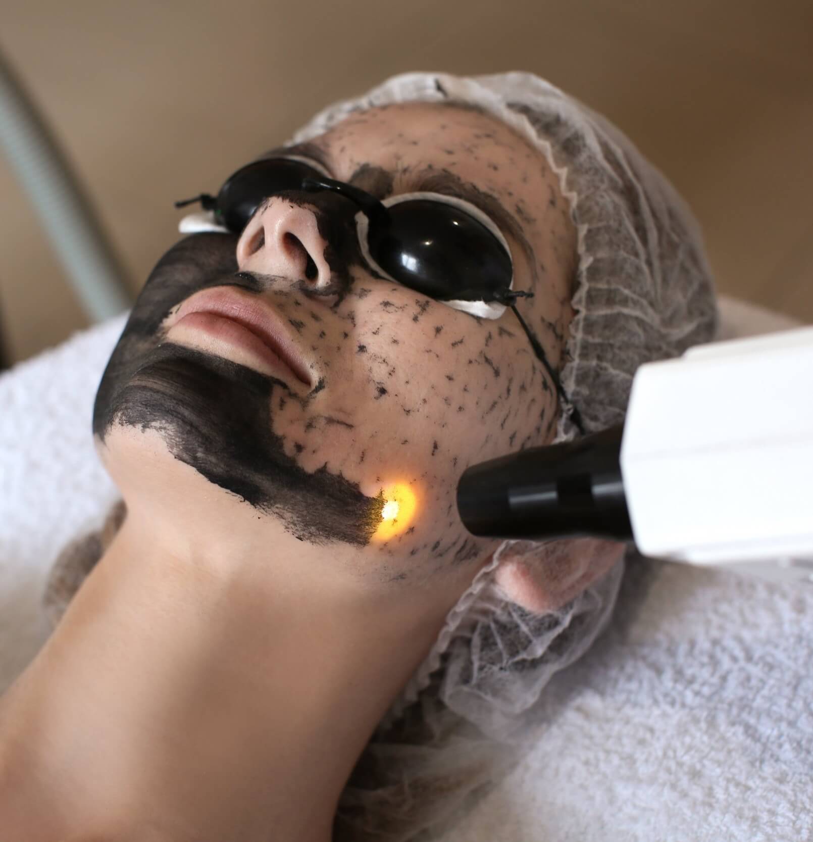 carbon laser peel treatment in thane