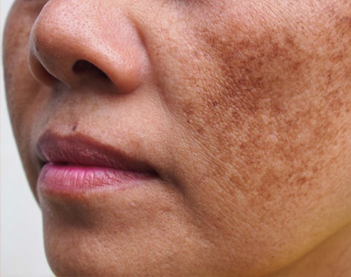 melasma treatment in thane