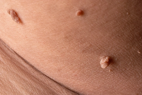 skin tags treatment in thane